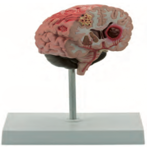 大脑及脑中风模型